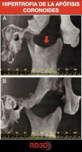 Hipertrofia de la apófisis coronoides