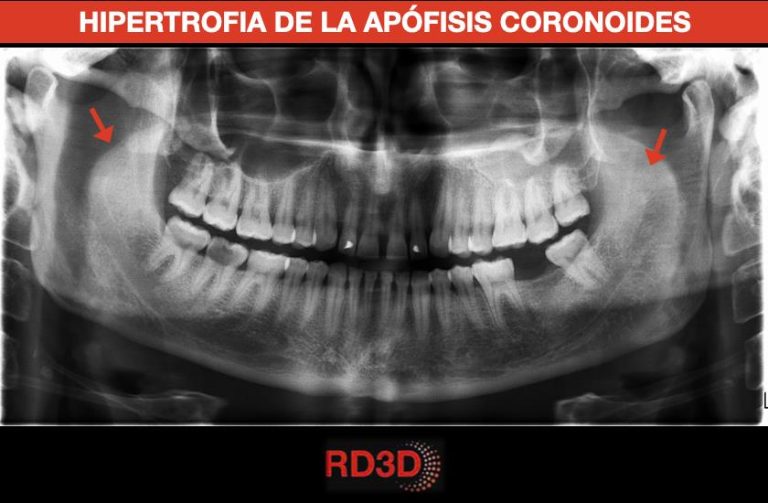 Hipertrofia de la apófisis coronoides