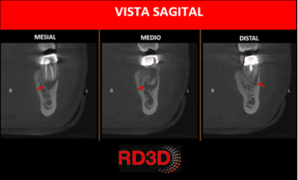 lesion endoperiodontal sagital cbct
