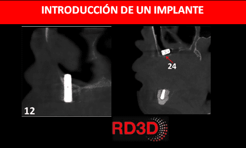 cuerpo extraño en el seno maxilar cbct