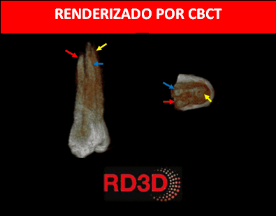premolar-superior-con-tres-raices-con-cbct