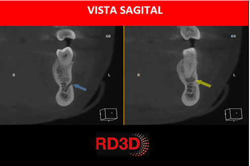 lesion apical asemejando agujero mentoniano sagital cbct