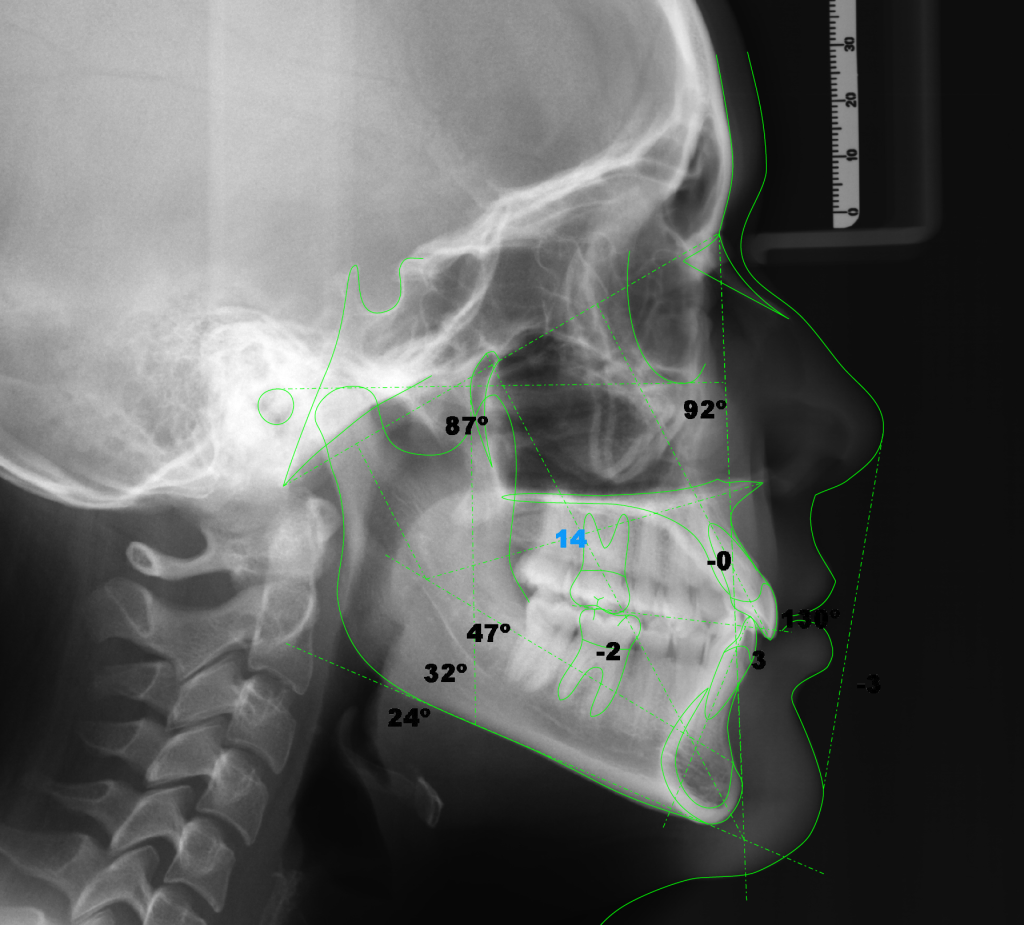 Fig. 3: Cefalometría en 2D a través de una Telerradiografía.
