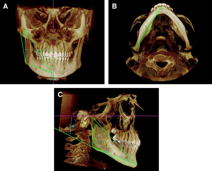 Fig. 4a, b, c: Cefalometría en 3D a través de un CBCT.