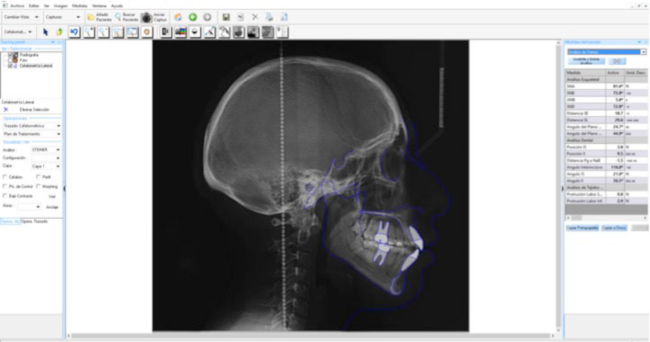 Fig. 1: Cefalometría digital.